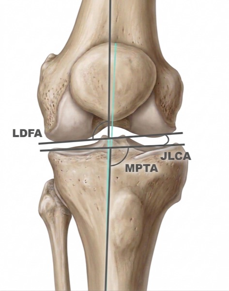 Ángulos coronales de la rodilla
