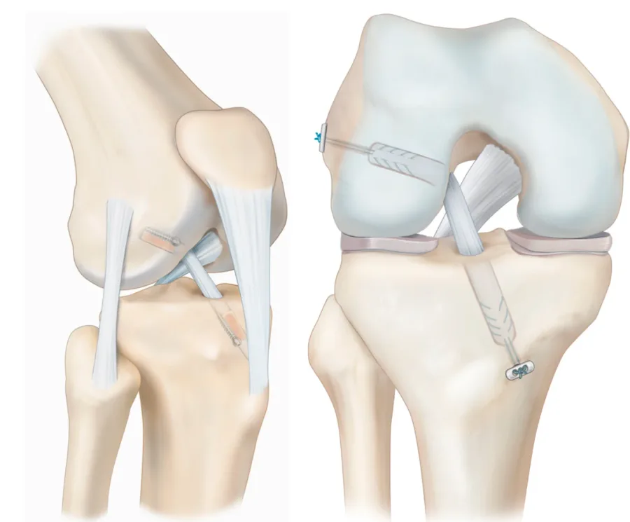 Plastia del LCA: injerto colocado a trav&eacute;s de t&uacute;neles &oacute;seos en f&eacute;mur y tibia