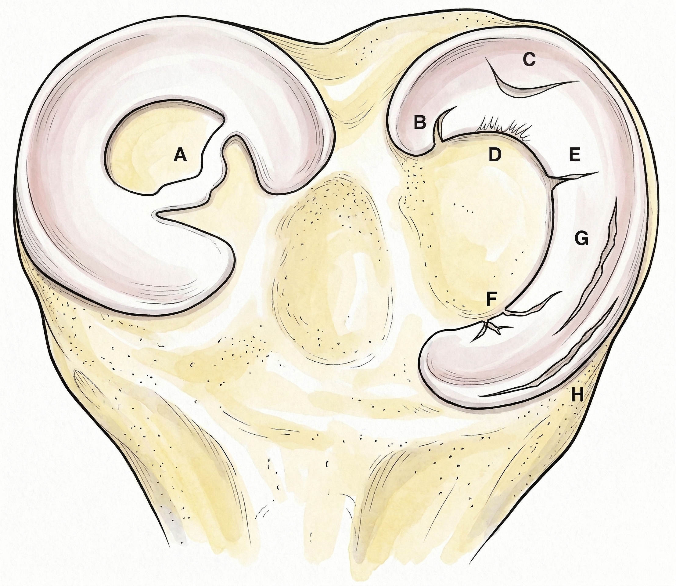 Tipos de roturas meniscales vistas desde arriba de la tibia: asa de cubo, pico de loro, flap, degenerativa, horizontal, compleja, longitudinal y radial