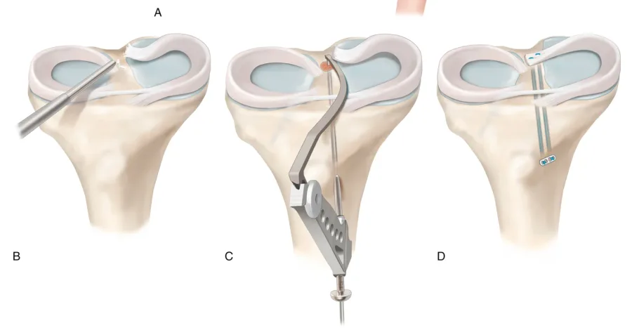 Secuencia de reinserción de raíz meniscal