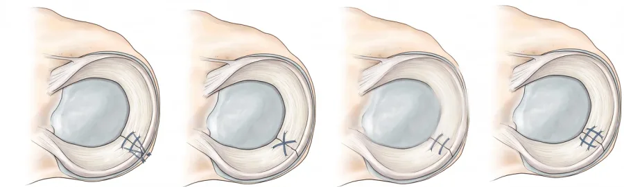 Diferentes configuraciones de sutura meniscal