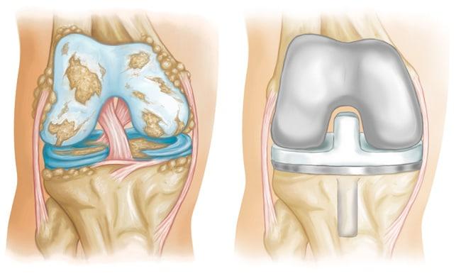 Comparaci&oacute;n de rodilla con artrosis (izquierda) y rodilla con pr&oacute;tesis total implantada (derecha)