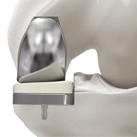 Pr&oacute;tesis unicompartimental de rodilla: reemplazo de un solo compartimento