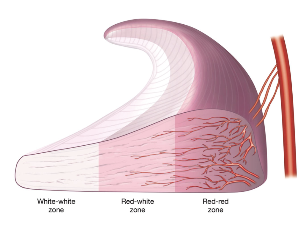 Vascularizaci&oacute;n del menisco: zona roja-roja (perif&eacute;rica, bien vascularizada), zona roja-blanca (intermedia) y zona blanca-blanca (central, sin riego)