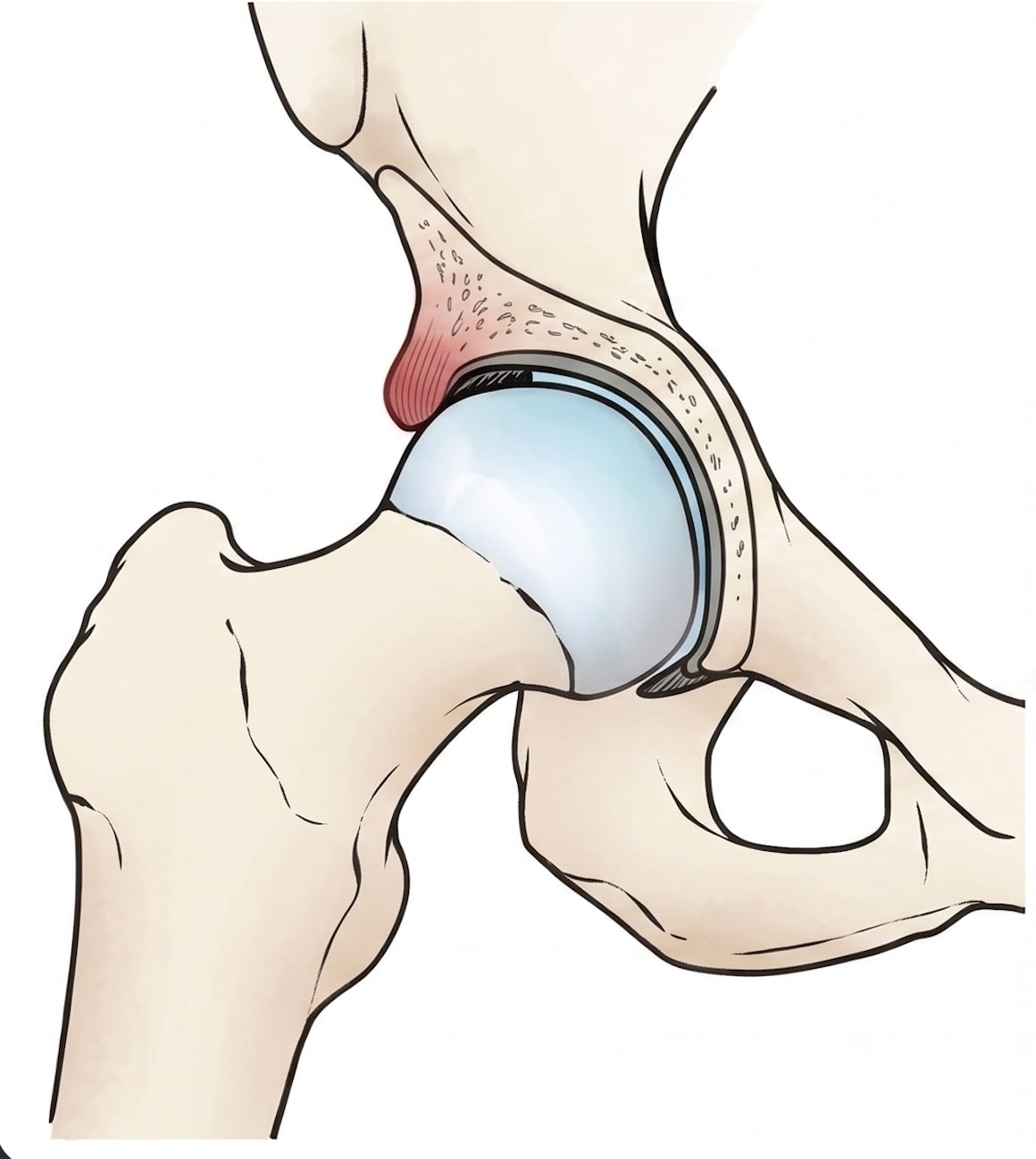 Morfología pincer: borde acetabular sobresaliente