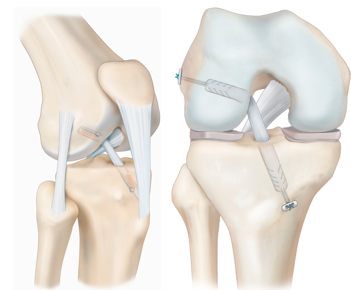 Reconstrucción del ligamento cruzado anterior