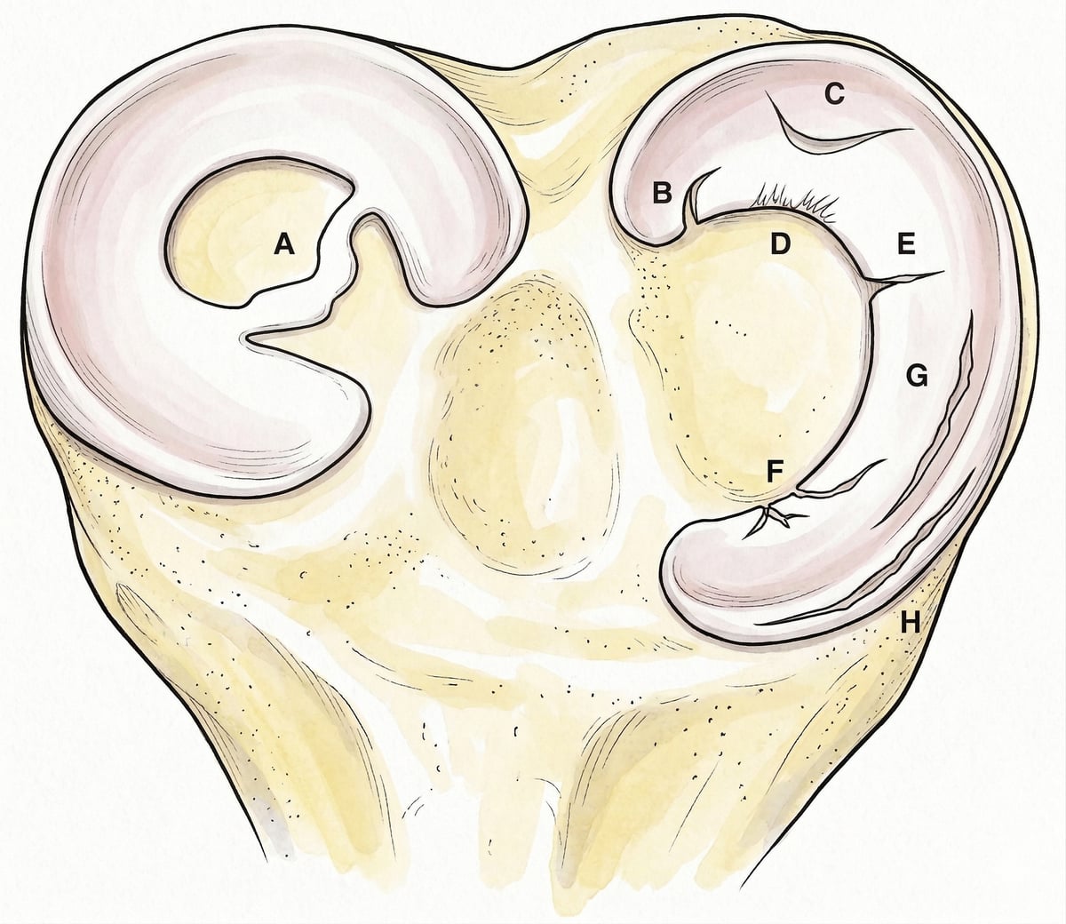 Patrones de rotura meniscal