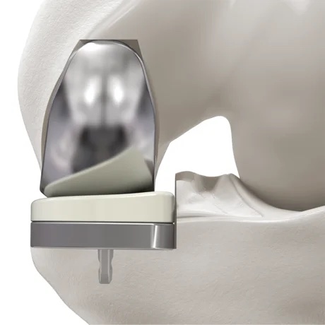 Prótesis Unicompartimental de rodilla